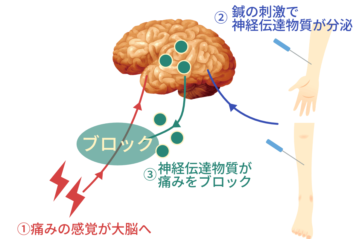 鍼の刺激で神経伝達物質が分泌を促す